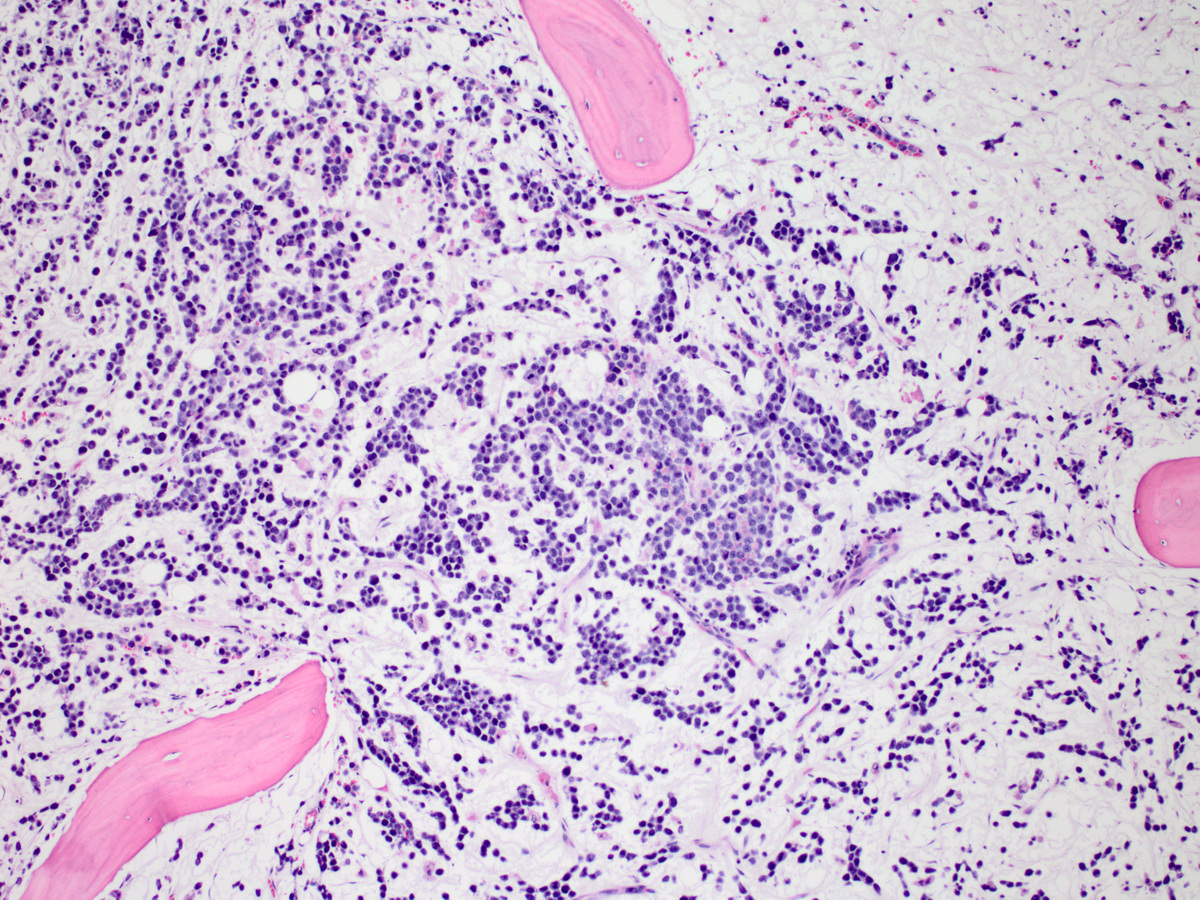 Intermediate power image of bone marrow biopsy section showing diffuse infiltrate of atypical cells in a background of myxoid-appearing stroma (x100, H&E)